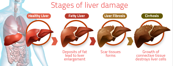 alcoholic fatty liver disease